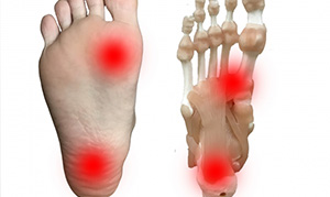 足底腱膜炎・筋膜炎（踵の痛み）